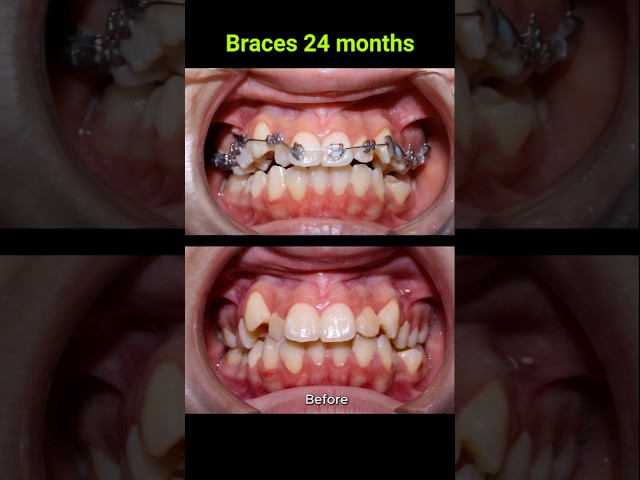 Braces correct all cases of crooked teeth #braces #orthodontist #bracket