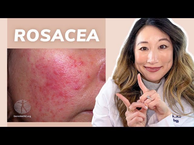 Dermatologist Guide to ROSACEA - Treatments & Skincare Products