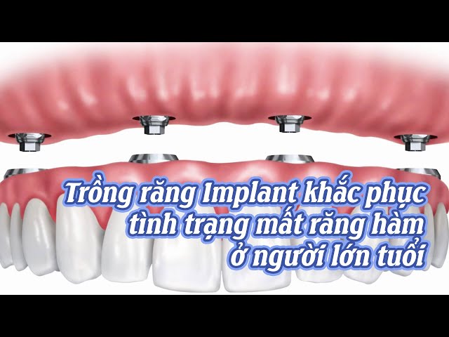 Trồng Răng Implant Khắc Phục Tình Trạng Mất Răng Hàm Ở Người Lớn Tuổi