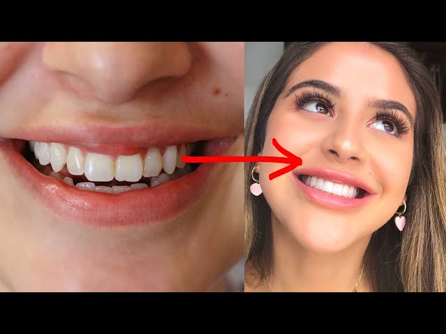 1 WEEK SMILE TRANSFORMATION (VENEERS)