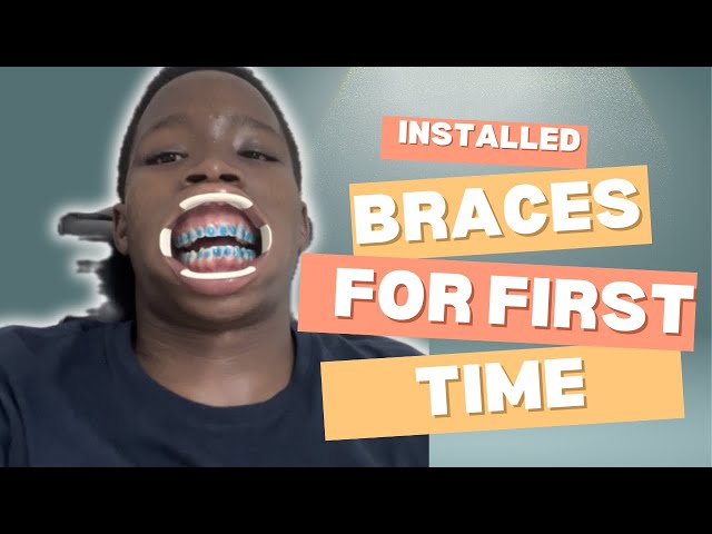 Come with me and install braces 😬