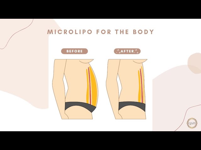 How Does MicroLipo Remove Fat? Learn with Dr. Nadir Qazi