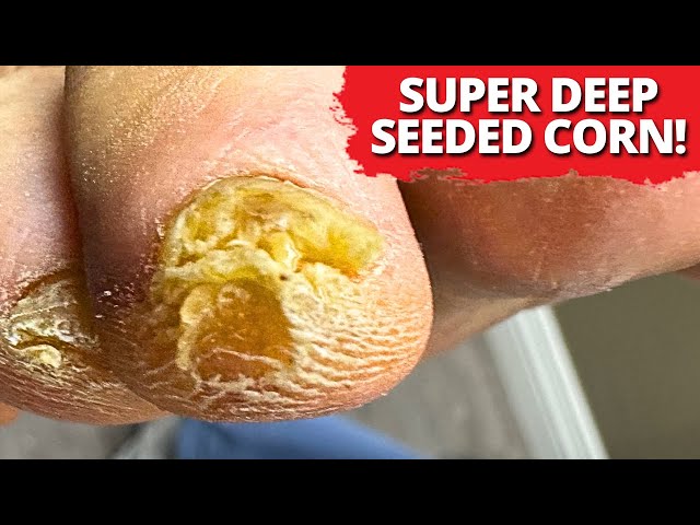 DEEP Corn Removal On Tip Of The Toe!