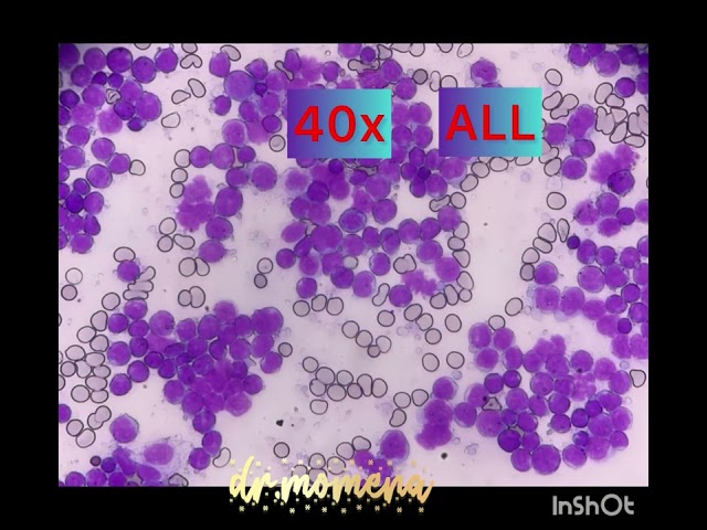 Bone marrow morphology of Acute Lymphoblastic Leukemia (ALL)