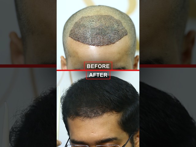 How Hair Transplant ChangedMy Life In 6 Months #hairtransplantresults