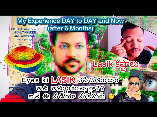 Lasik or Laser Surgery for Eyes in Telugu || My experience of Lasik surgery after 6 months #lasik