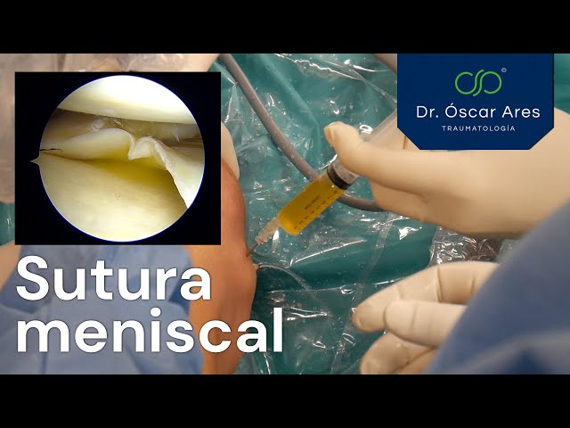 Rotura de menisco - Sutura meniscal - Dr. Oscar Ares