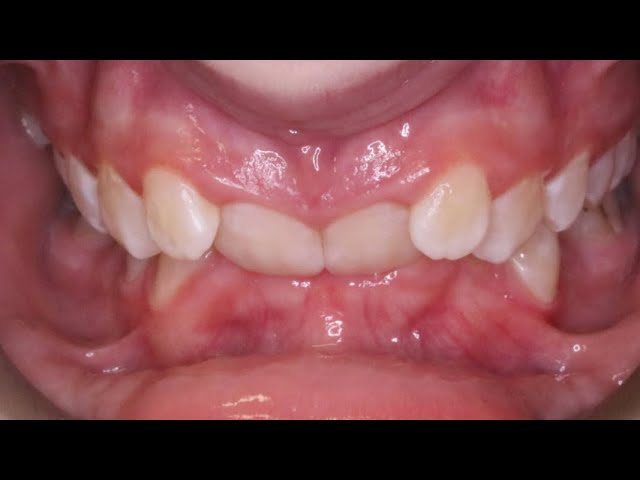 Điều trị cắn sâu bằng phương pháp niềng răng #orthodontist