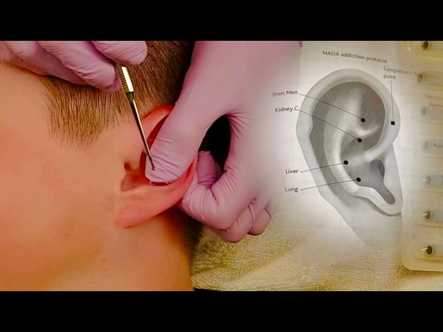 Ear Seeding for Migraines, Sciatica, Asthma, and Addiction👂🏼 [Natural Speaking ASMR] 🧡 NO MUSIC