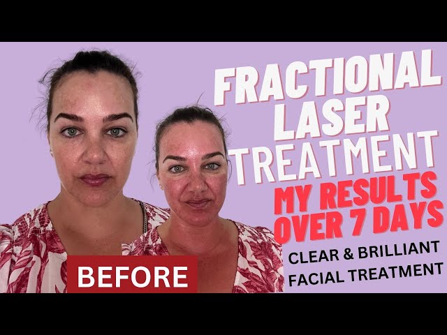 CLEAR & BRILLIANT Fractional laser treatment - My results over 7 days!