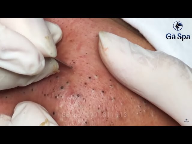 Best Blackhead Removal Ever 55min - Facial Acne Treatment - Gà Spa