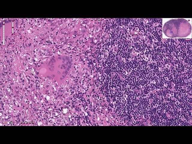 Tuberculosis of the Lymph Node - Histopathology