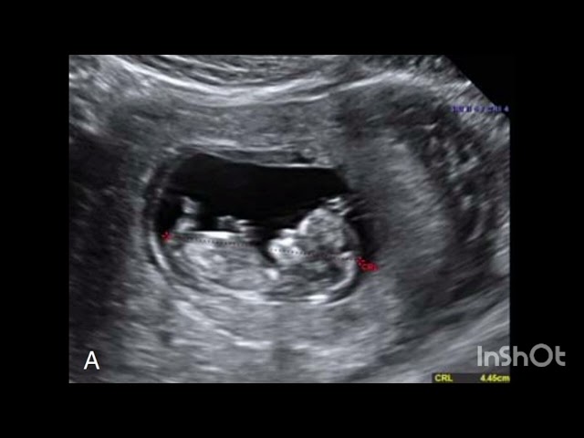 Perfecting Crown-Rump Length Measurement for Accurate Dating in Ultrasound