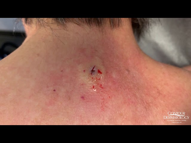 Blackhead (Jelly Bean) Extraction From Behind the Neck