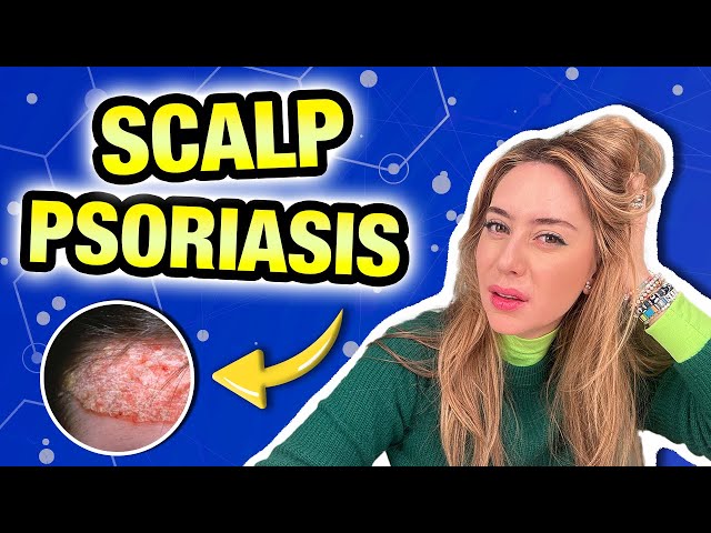 Scalp Psoriasis: Top Tips & Derm-Approved Treatments for Dry, Flaky Scalp! | Dr. Shereene Idriss