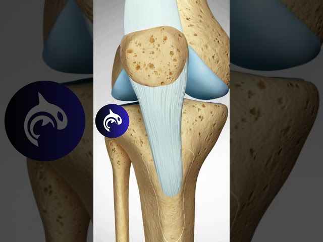 See how a Misaligned Knee Cap is fixed // Tibial Tubercle Osteotomy (TTO)