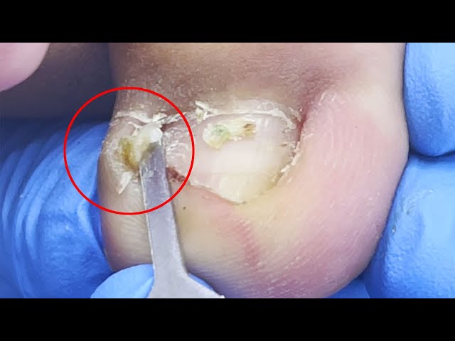 Mild inflammation of the toenail, with one side of the nail extending 3 mm into the flesh