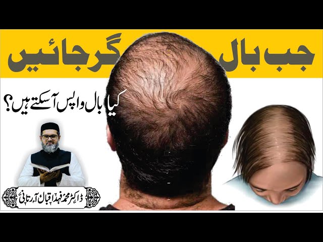 BAAL GIRNA BAND - No HAIR FALL - Dr. Fahad Artani Roshniwala