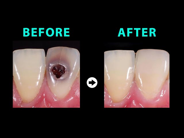 Trước và sau làm răng sứ | Before after restores bad teeth