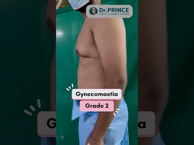 No scar gynecomastia surgery/ dr prince plastic surgeon