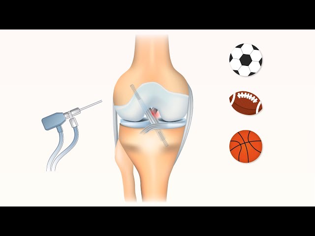 Second ACL revision vs nonsurgical management