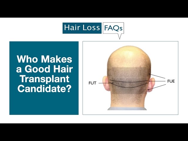 Who Makes a Good Hair Transplant Candidate?