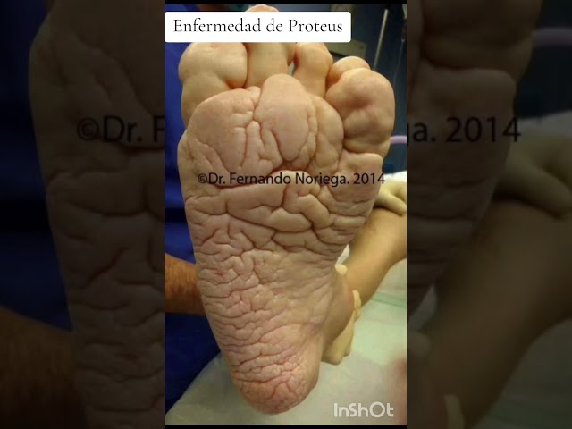 Sindrome de Proteus #podología #podologo #pies #proteus