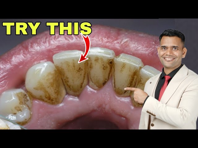 1 Simple Home Remedy For Yellow Teeth, Dental Plaque, Cavities