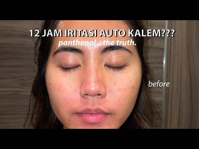 12 JAM Kulit Auto Kalem?? 5% Panthenol : The Truth