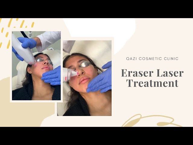 Eraser Laser Treatment with Ultra MD | Live with Dr. Nadir Qazi