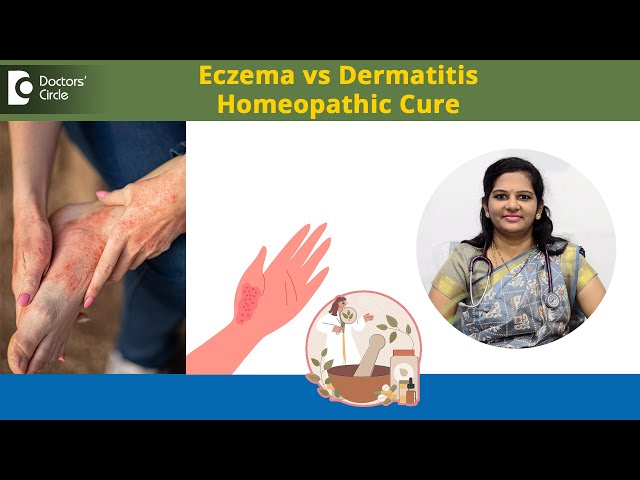 Eczema vs Dermatitis & Effective Complementary Homeopathic Treatment-Dr. Vindoo C |Doctors' Circle