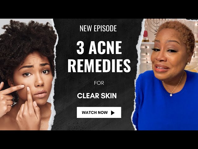 3 Acne Remedies for Pimples