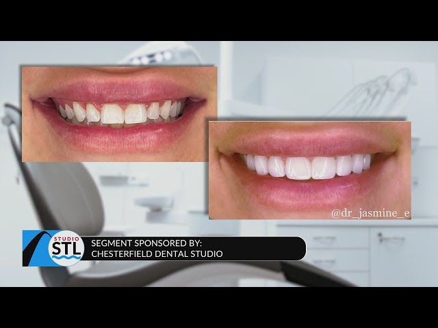 Why do veneers have a bad rep? Chesterfield Dental Studio debunks myths