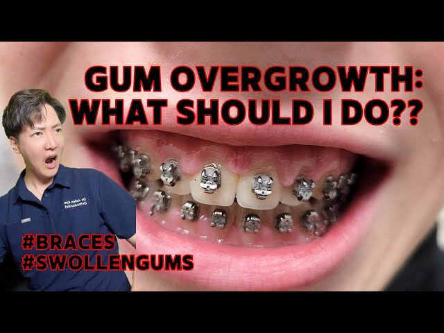 Gum Overgrowth with Braces.. What Should I Do??