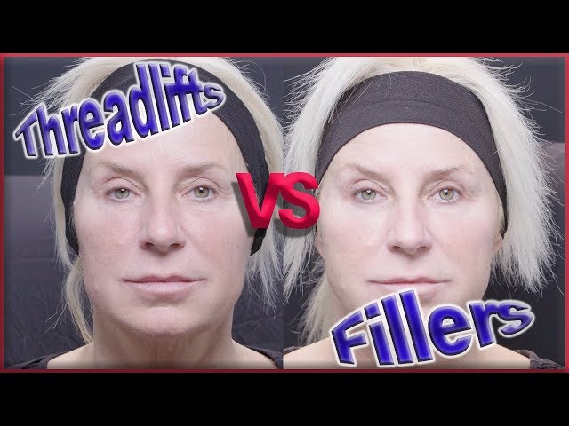 Threadlifts vs Fillers