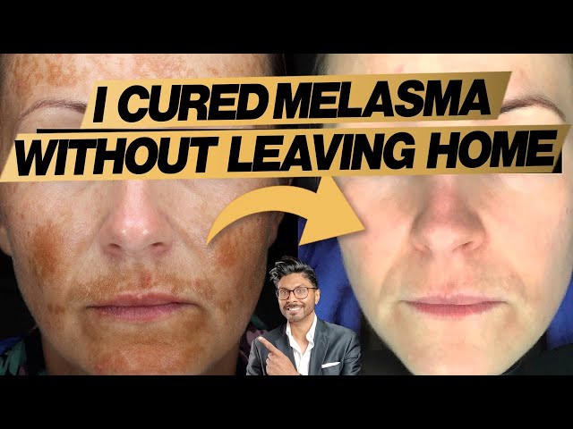 Melasma Treatment At Home: Expert Doctor's 3 Easy Steps (+ before and after)