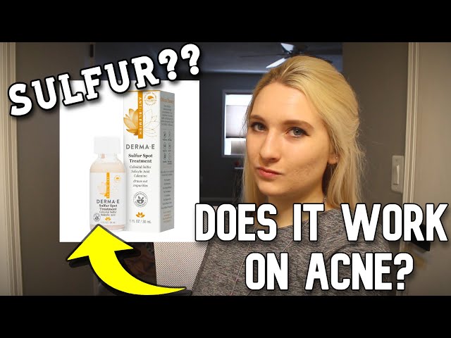 Derma E Sulfur Spot Treatment - Does it work on Acne-Prone Skin?? MY RESULTS