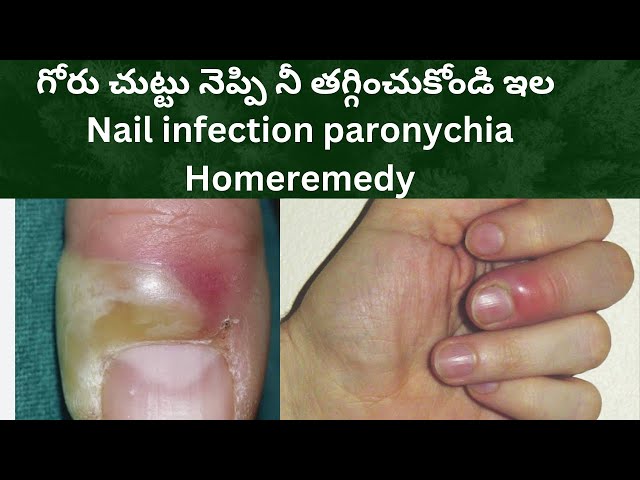 గోరుచుట్టు | Goru chuttu Home Remedy | Nail infection treatment athome | paronychia | Best remedy