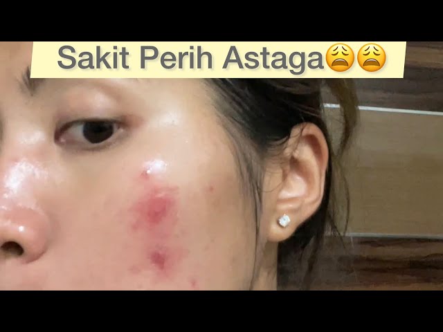 Derita Acne Prone Sensitive Skin