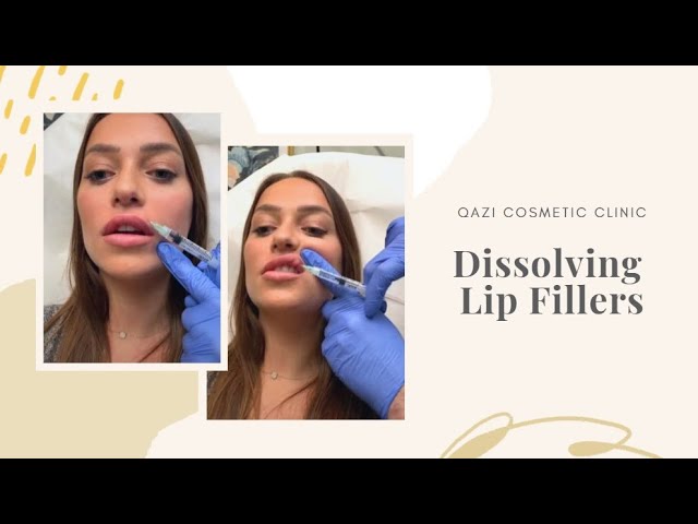 Dissolving Lip Fillers | Live with Dr. Nadir Qazi