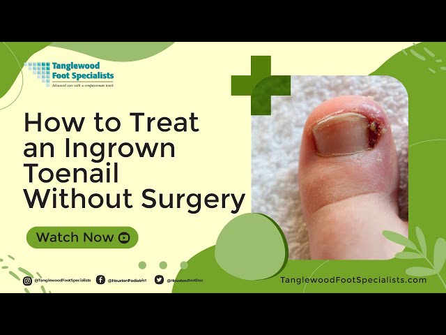 How to Treat an Ingrown Toenail Without Surgery