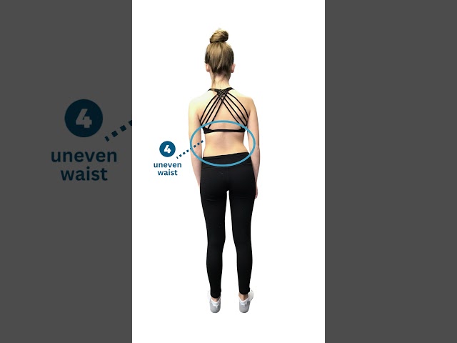 Scoliosis Sign #4: Uneven Waist