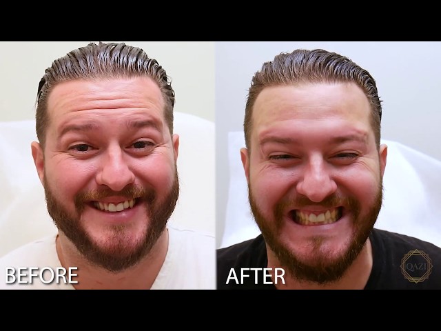 Botox Before & After For Men - Irvine, CA (Using Botox, Xeomin, Dysport)