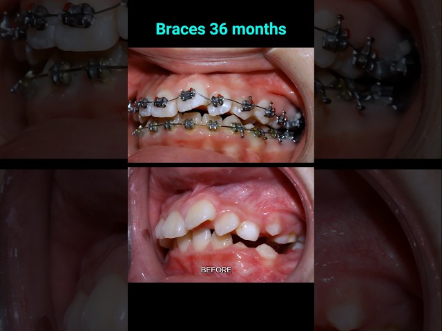 Fix buck and crooked teeth with 36 months braces #orthodontist #dentist #braces