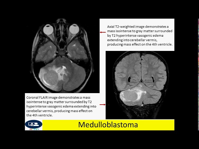 Medulloblastoma