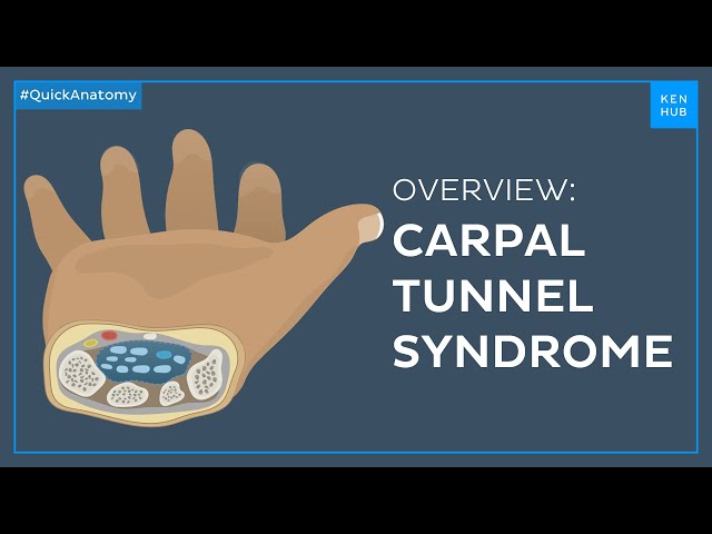 Carpal tunnel syndrome: Symptoms, causes, treatment - Quick Anatomy | Kenhub