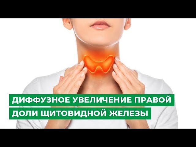 Диффузное увеличение правой доли щитовидной железы