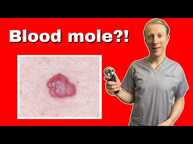 Haemangioma, Adult Onset: Doctor Explains Why That's Not A Mole!