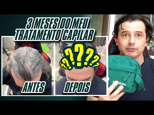 TESTEI o TRATAMENTO de QUEDA DE CABELO da MANUAL | FUNCIONA MESMO pra HOMENS e CALVÍCIE MASCULINA?