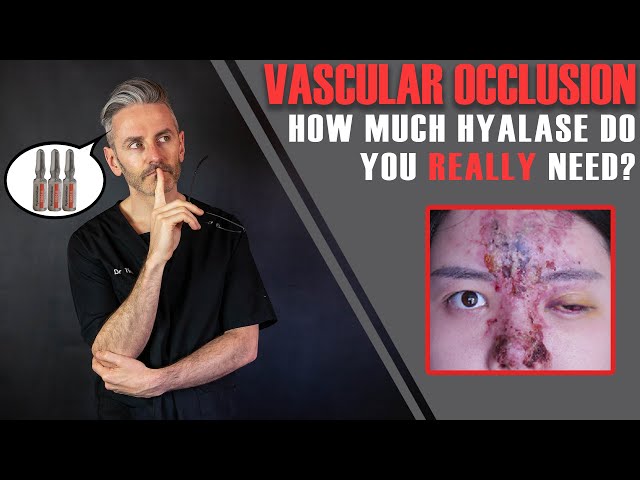 Vascular Occlusion: How Many Vials Of Hyalase Do You REALLY Need? [Aesthetics Mastery Show]